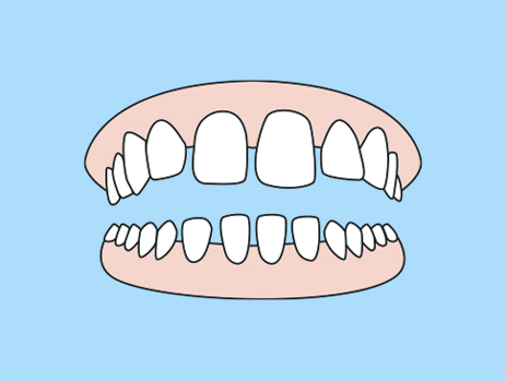 Teeth Gap