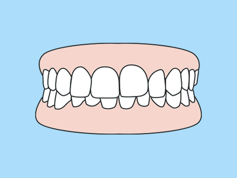 Teeth Gap